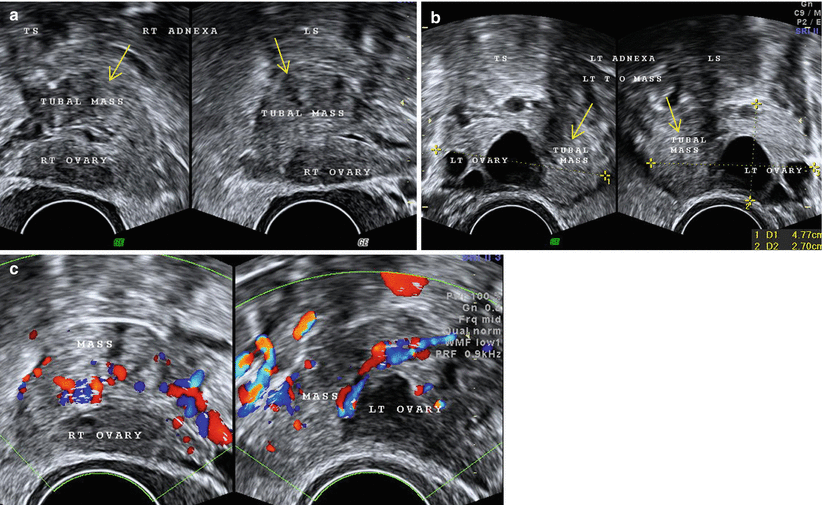 Ultrasound Evaluation Of Adnexal Pathology Springerlink