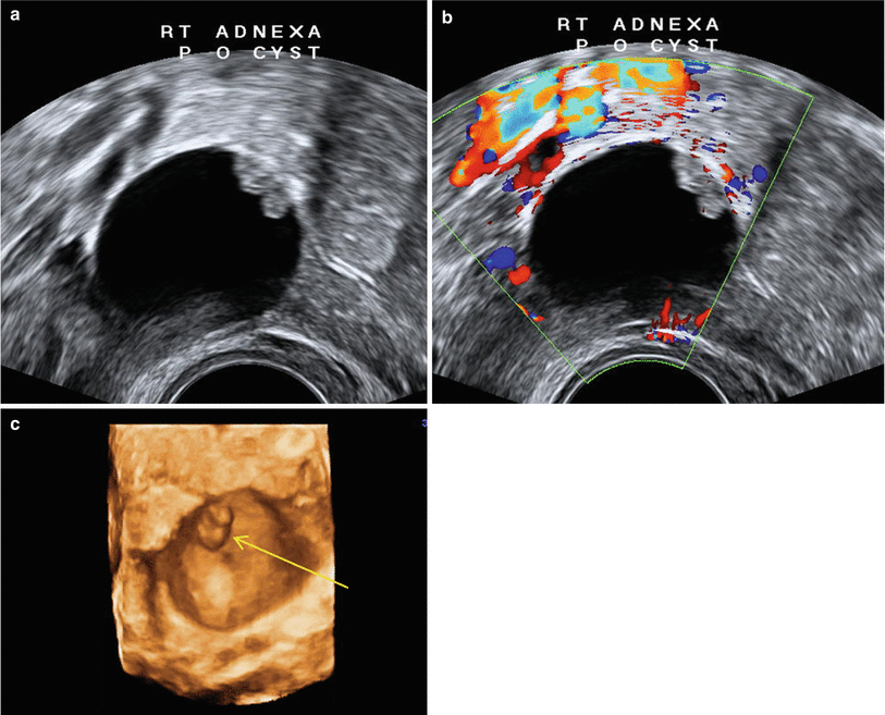 Ultrasound Evaluation Of Adnexal Pathology Springerlink