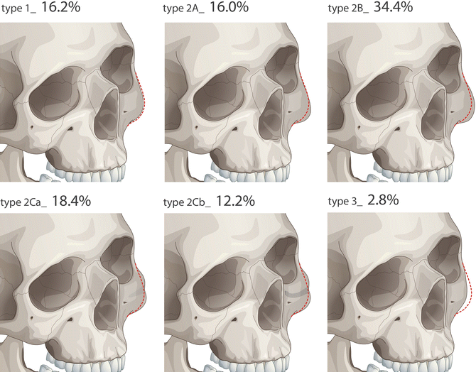 The Aesthetic Midface Analysis Diagnosis And Surgical Planning