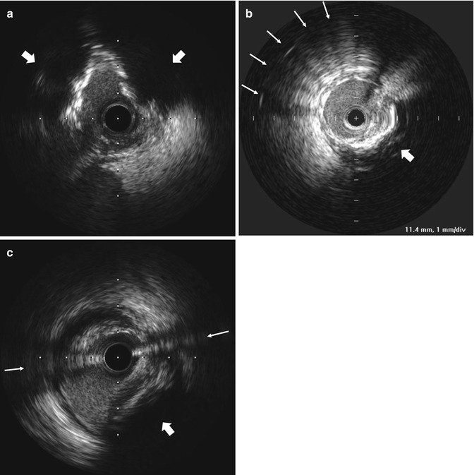 IVUS Artifacts and Image Control | SpringerLink
