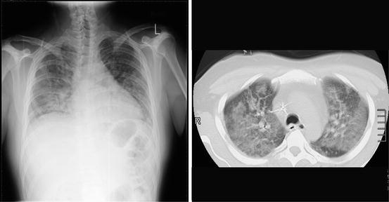 arsenic exposure x-ray arsenic exposure x-ray