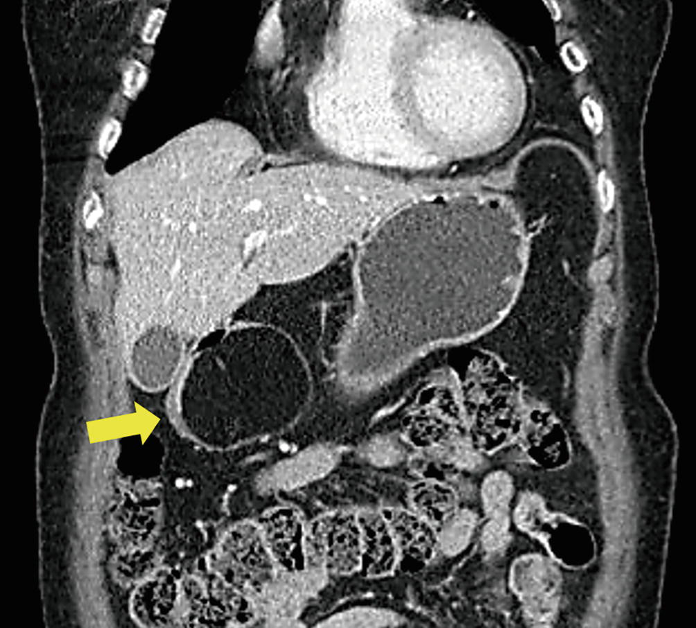 a duodenum neuroendokrin rákja