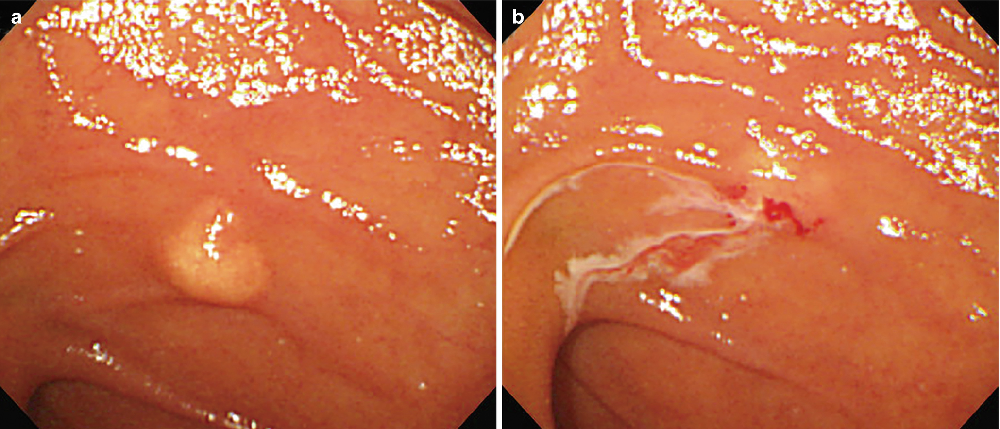 a duodenum neuroendokrin rákja