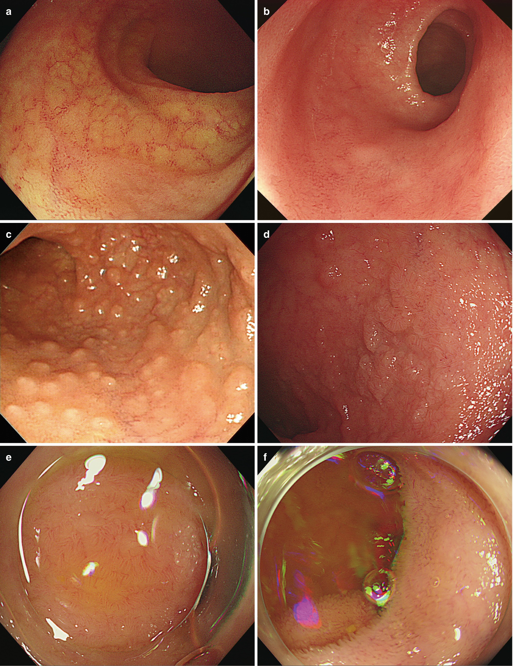 colonoscopy findings colonoscopy findings