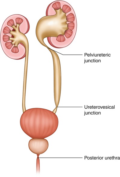 Hydronephrosis | SpringerLink