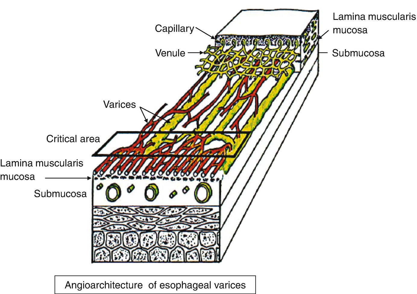 Pathological Findings for Esophageal Varices  SpringerLink