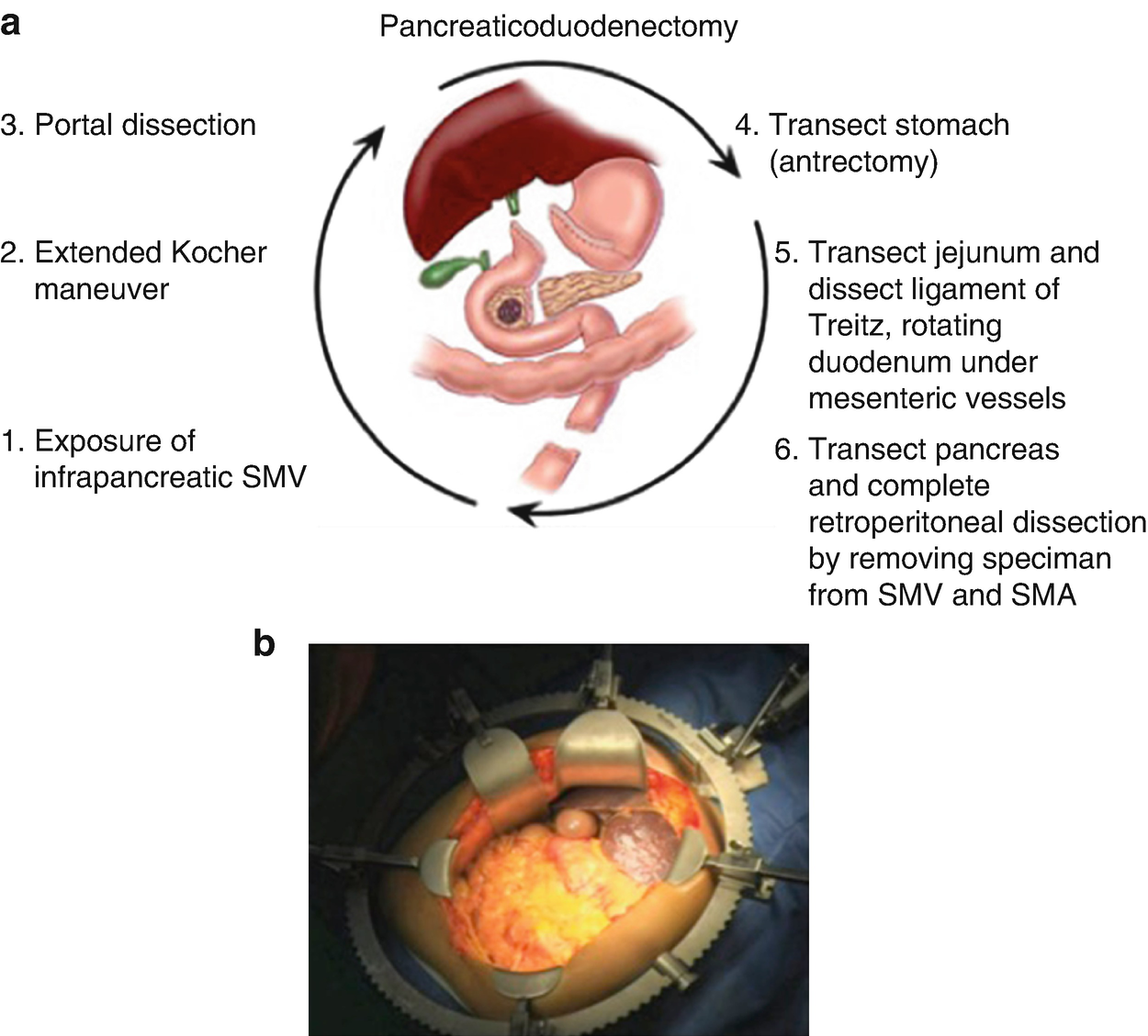 Pancreaticoduodenectomy For Cancer Key Steps Springerlink
