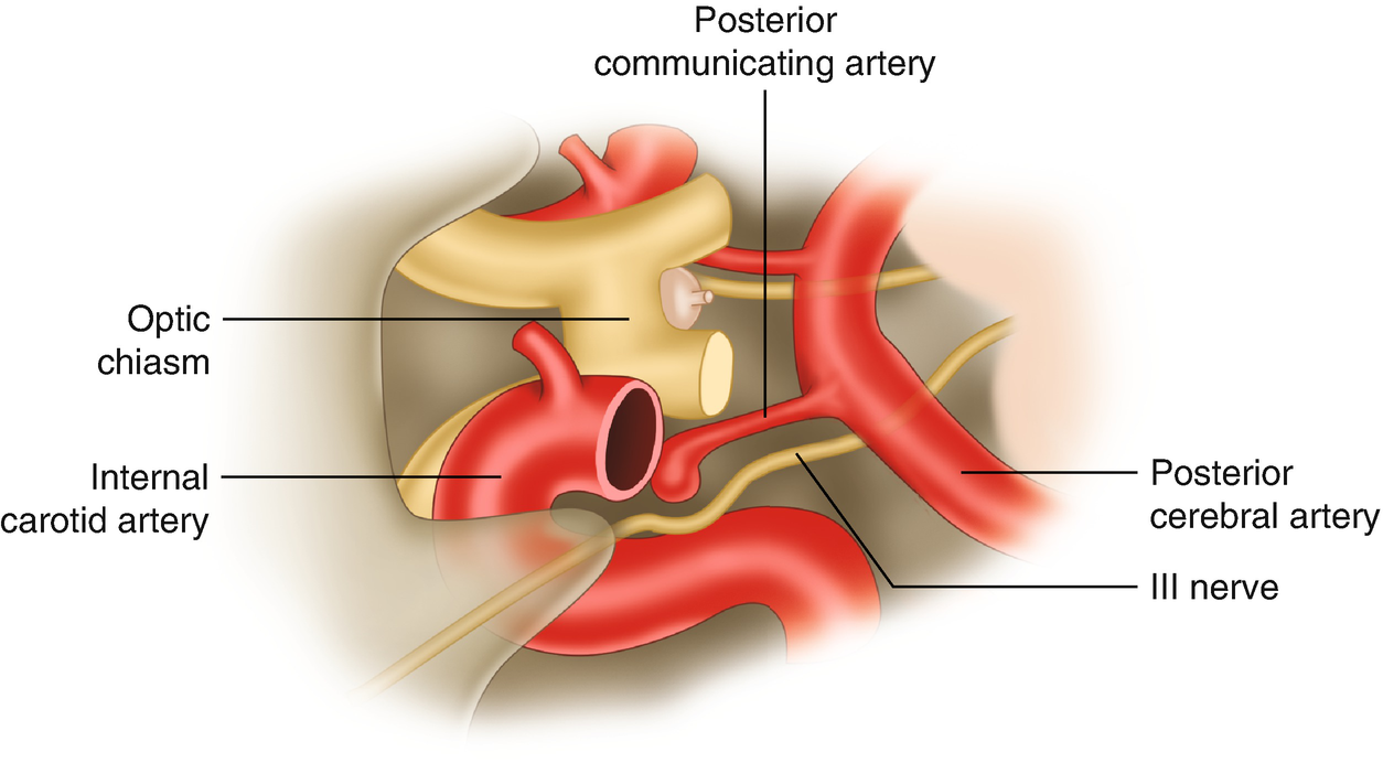 Pcom Aneurysm with Oculomotor Nerve Palsy (ONP) | SpringerLink Pcom Aneurysm with Oculomotor Nerve Palsy (ONP) | SpringerLink