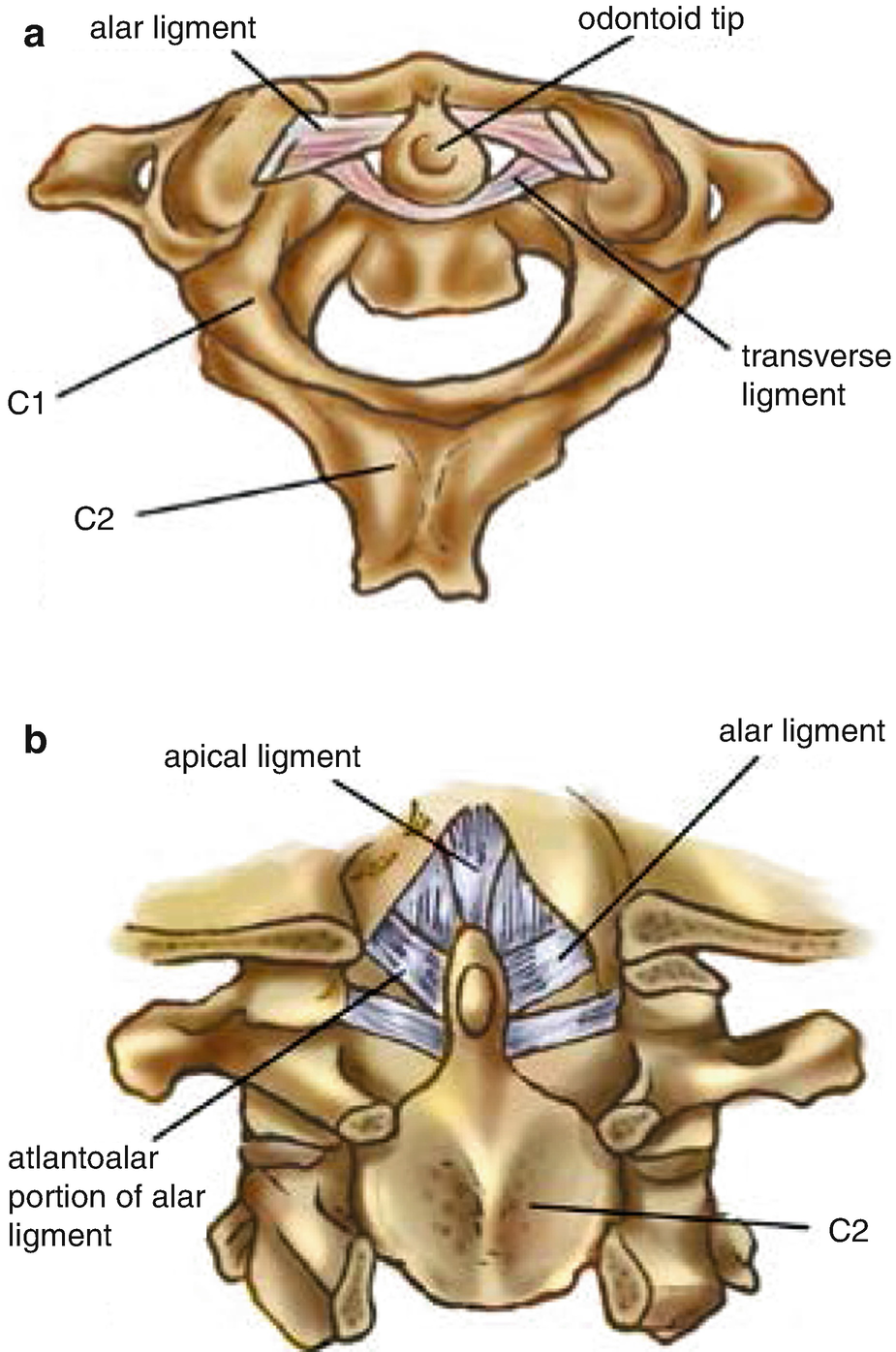 Tratament articular atlantoaxial, Articulare hernie occipitale
