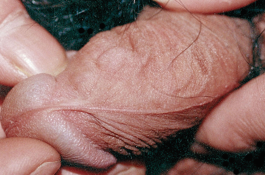 lymphangitis pénisz