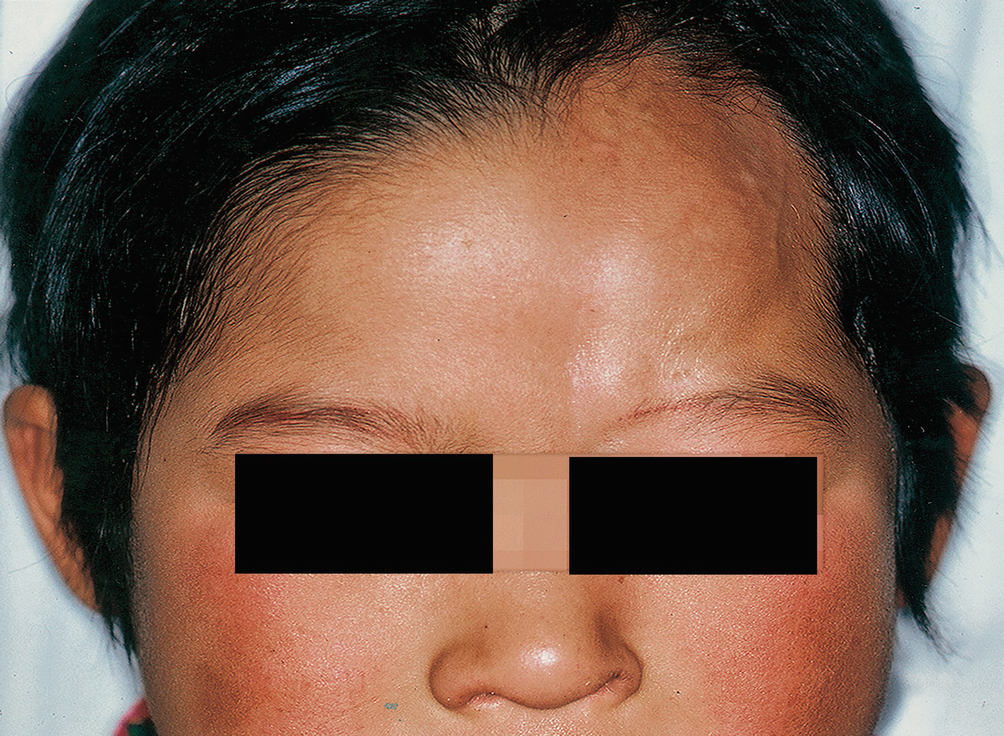 Non Inherited Cutaneous Syndromes Springerlink
