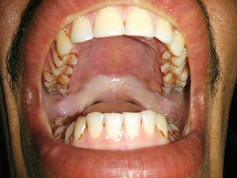 trismus in head and neck cancer causes and management trismus