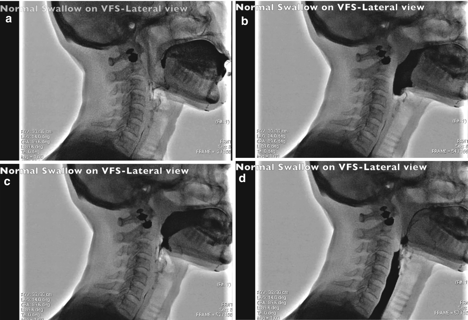 Components Of Swallow Impairments Causes Observations And Therapy Springerlink
