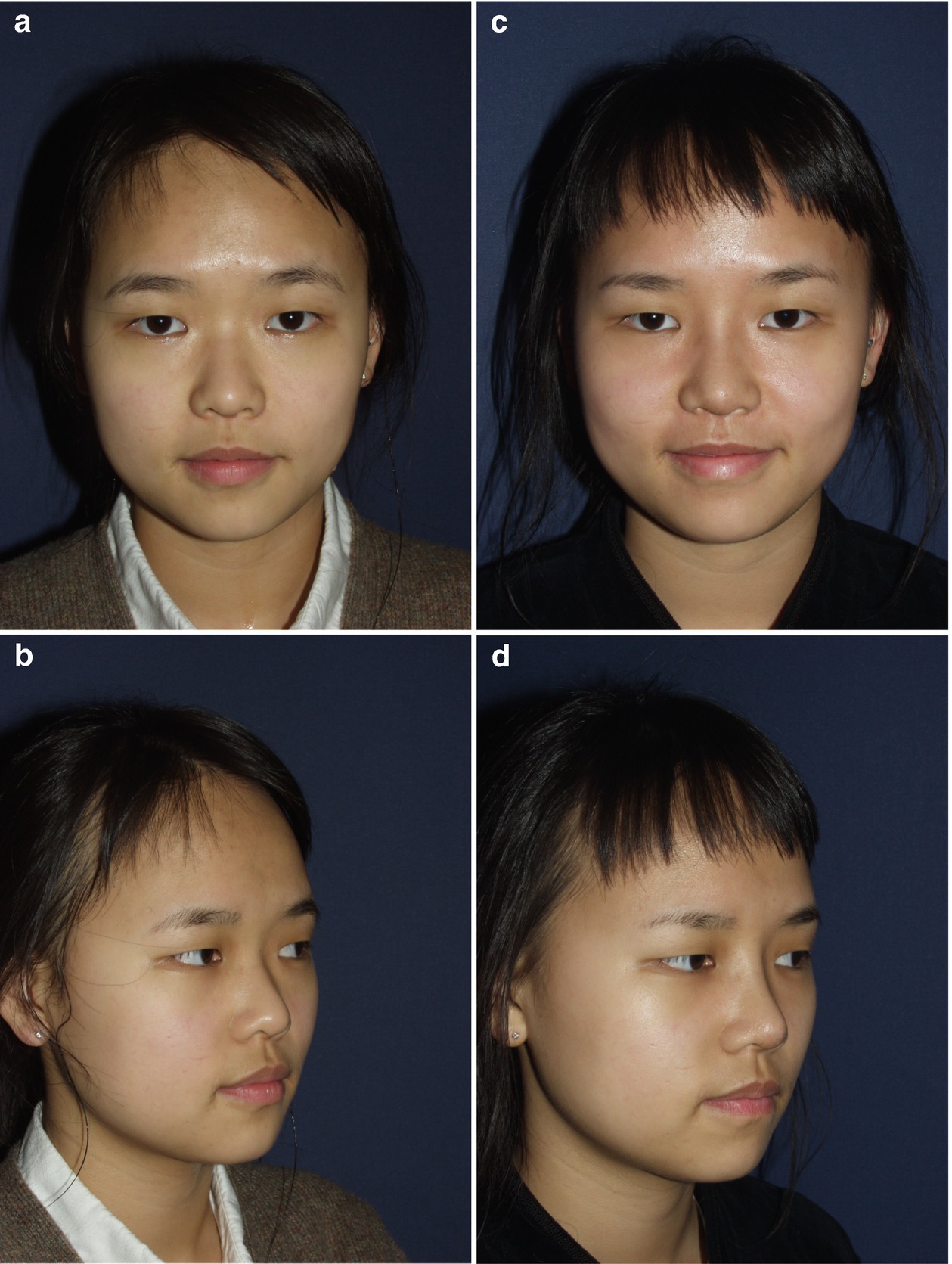 Short Nose Correction Springerlink