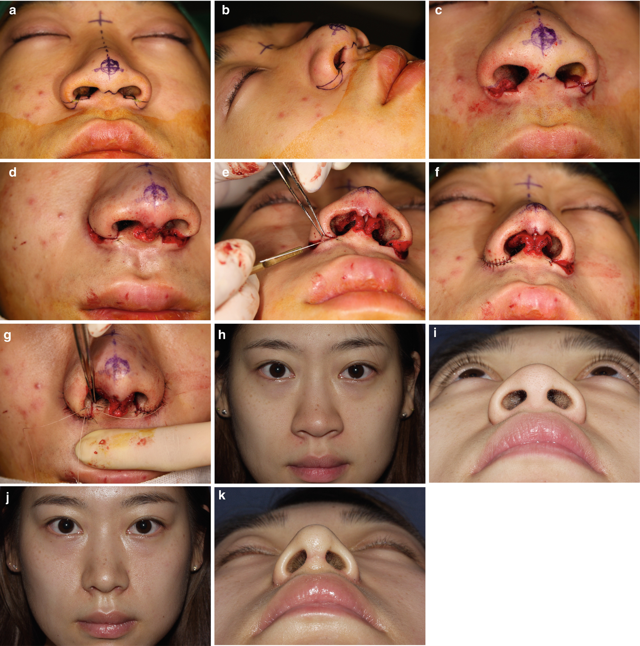 Correction Of Nostril And Alar Base Springerlink