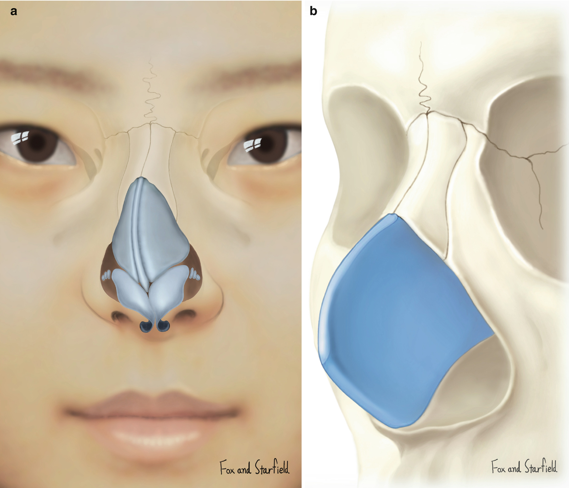 Deviated Nose Correction And Functional Rhinoplasty Springerlink
