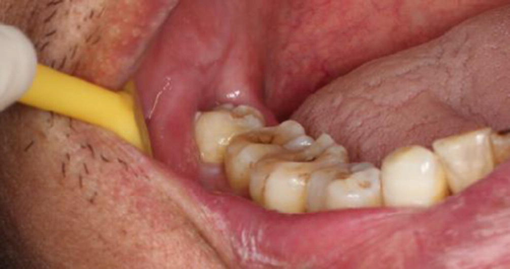 Erupted Wisdom Tooth | Best Dental