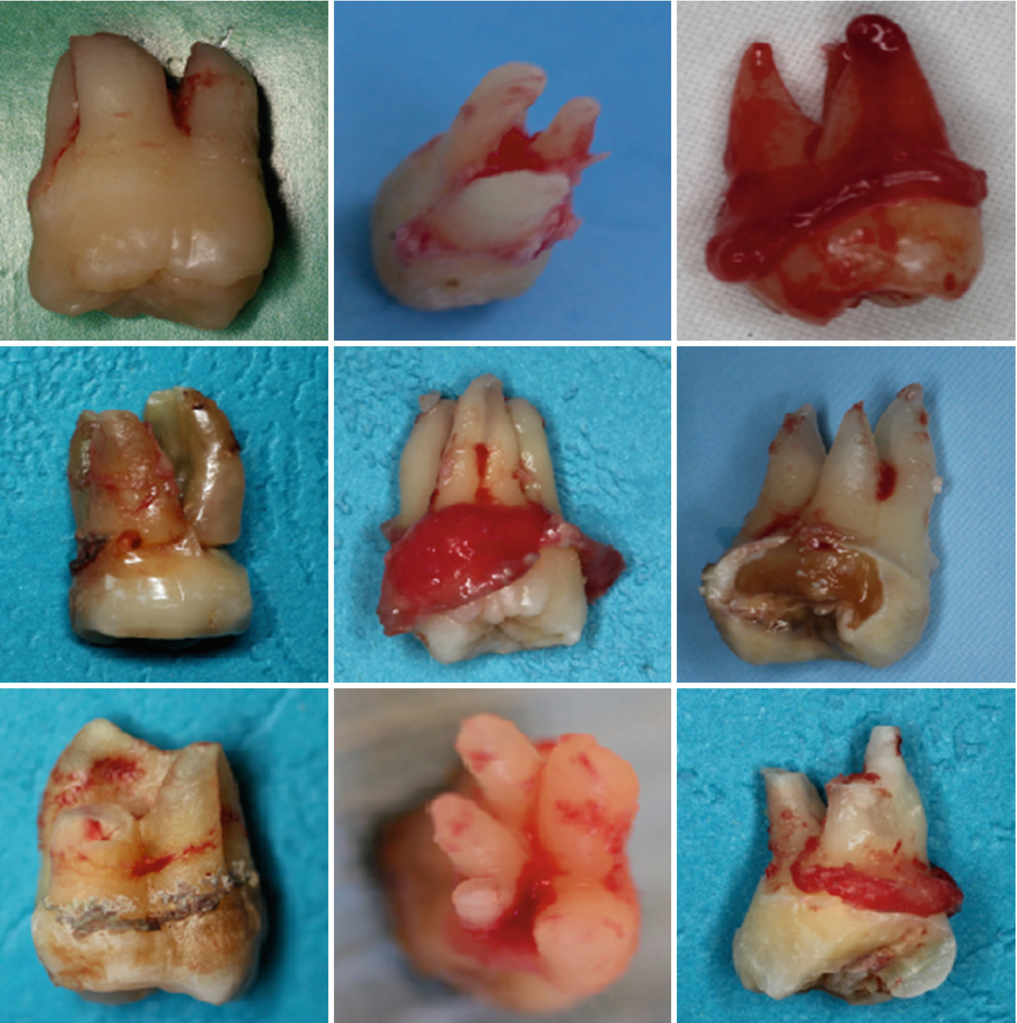 5 roots in molars 5 roots in molars