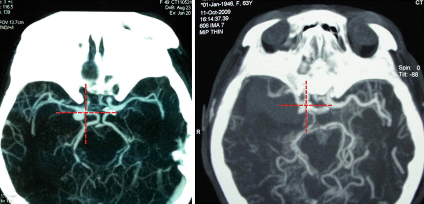 Surgery of Posterior Communicating Artery Aneurysm | SpringerLink Surgery of Posterior Communicating Artery Aneurysm | SpringerLink