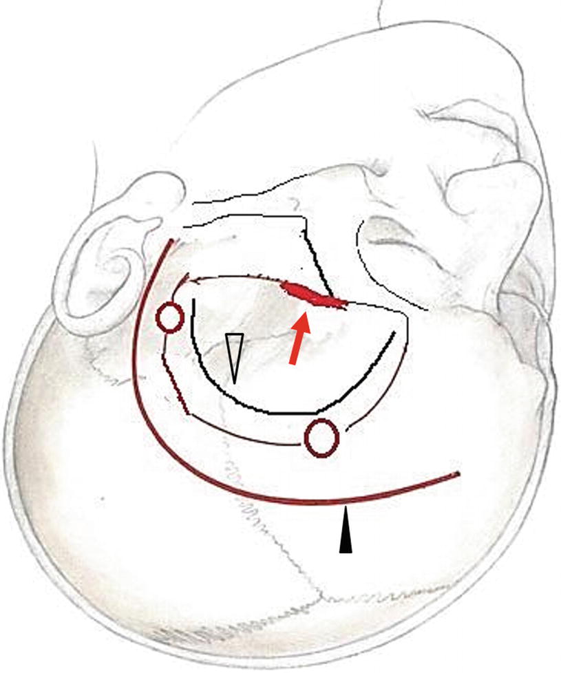 Surgery of Middle Cerebral Artery (MCA) Aneurysm | SpringerLink