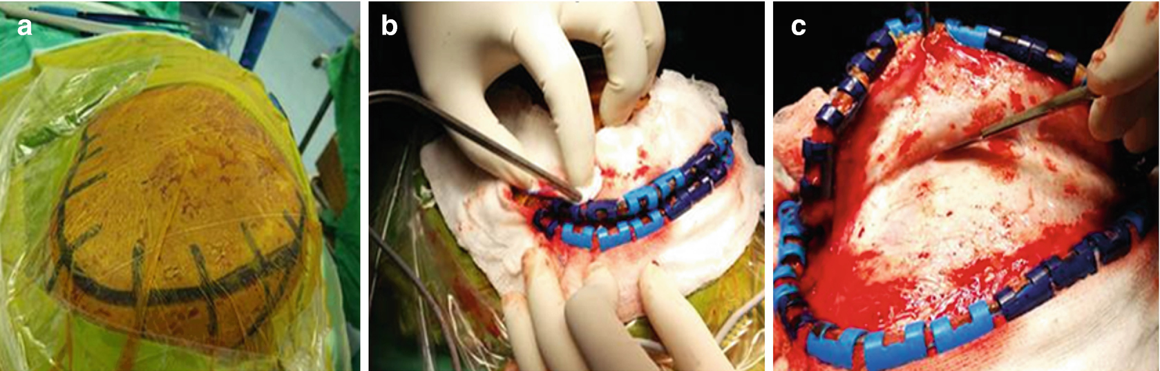 Surgery Of Intracerebral Hemorrhage Springerlink