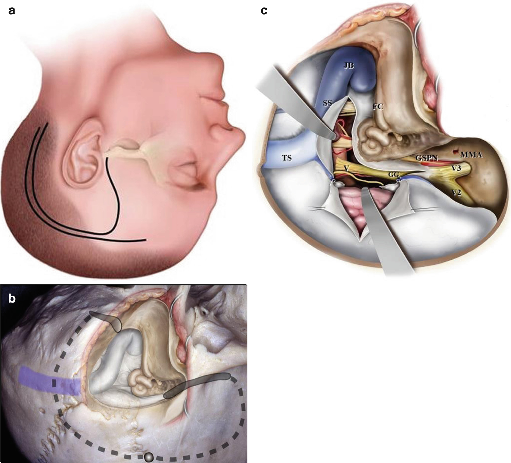 Transmastoid Approach For Retrolabyrinthine And Translabyrinthine Springerlink
