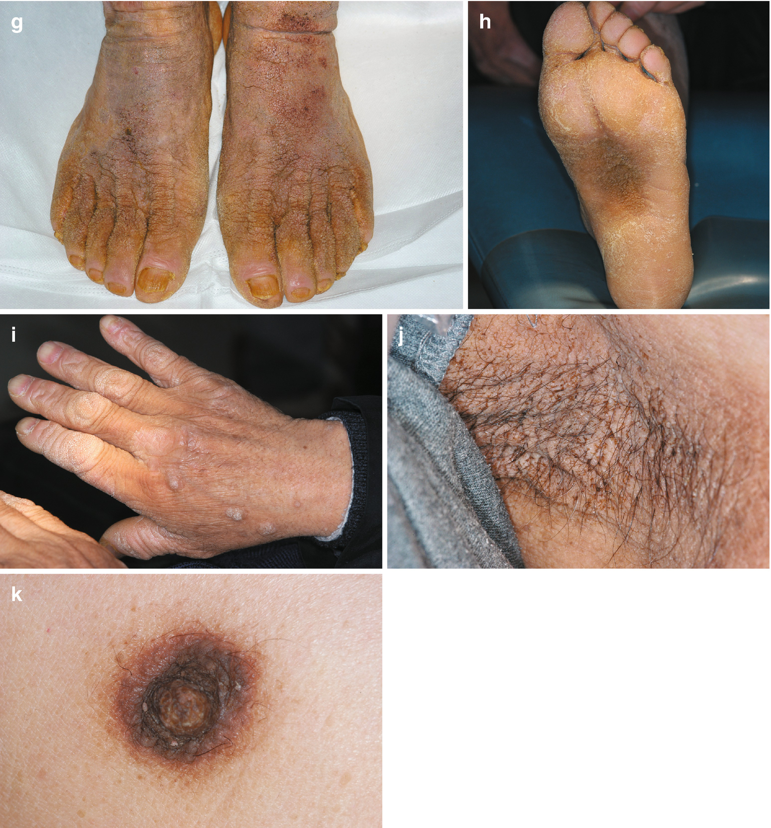 dermal papillomatosis