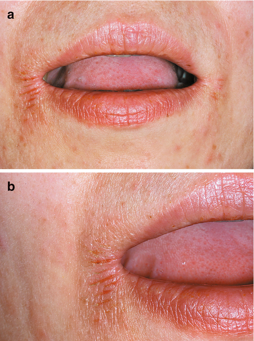 Labiolingual Diseases Springerlink