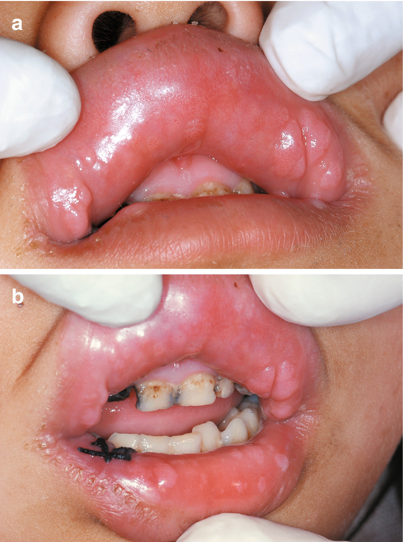 squamous papilloma lower lip)