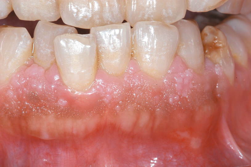 gingival papillomas)