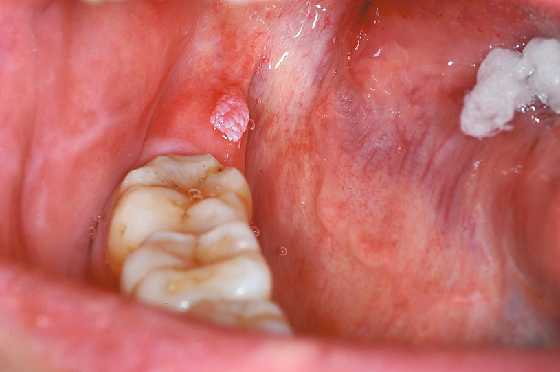 Mouth warts on gums