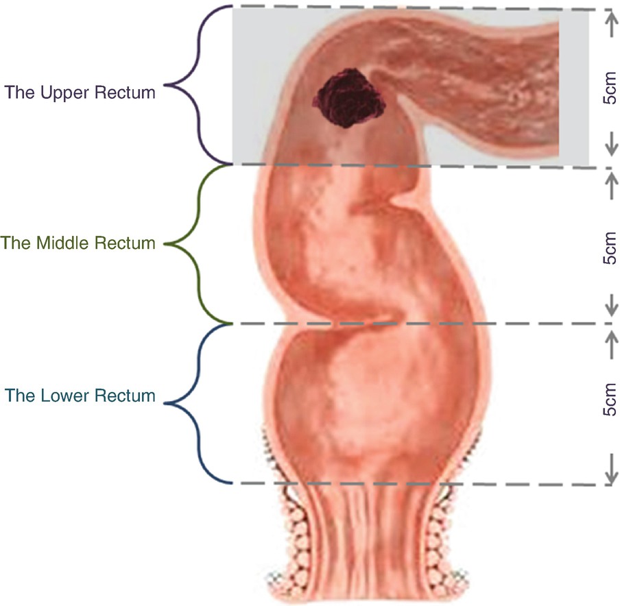 rectal cancer resection