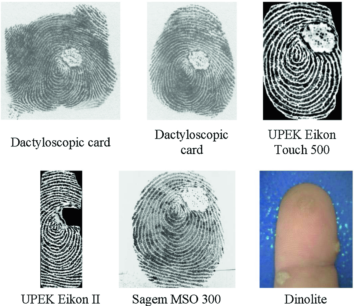 Influence Of Skin Diseases On Fingerprints Springerlink