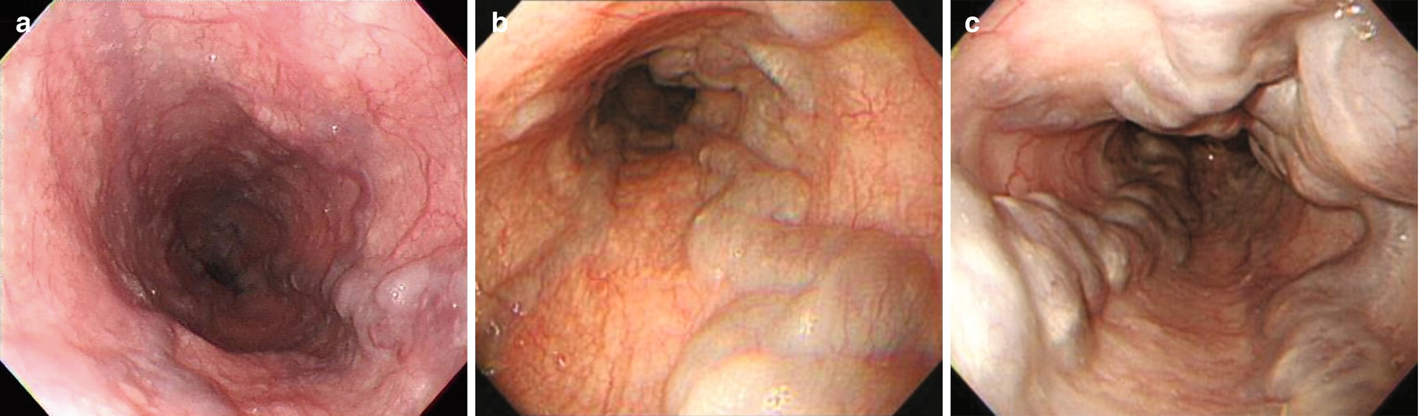varice tratament fistula