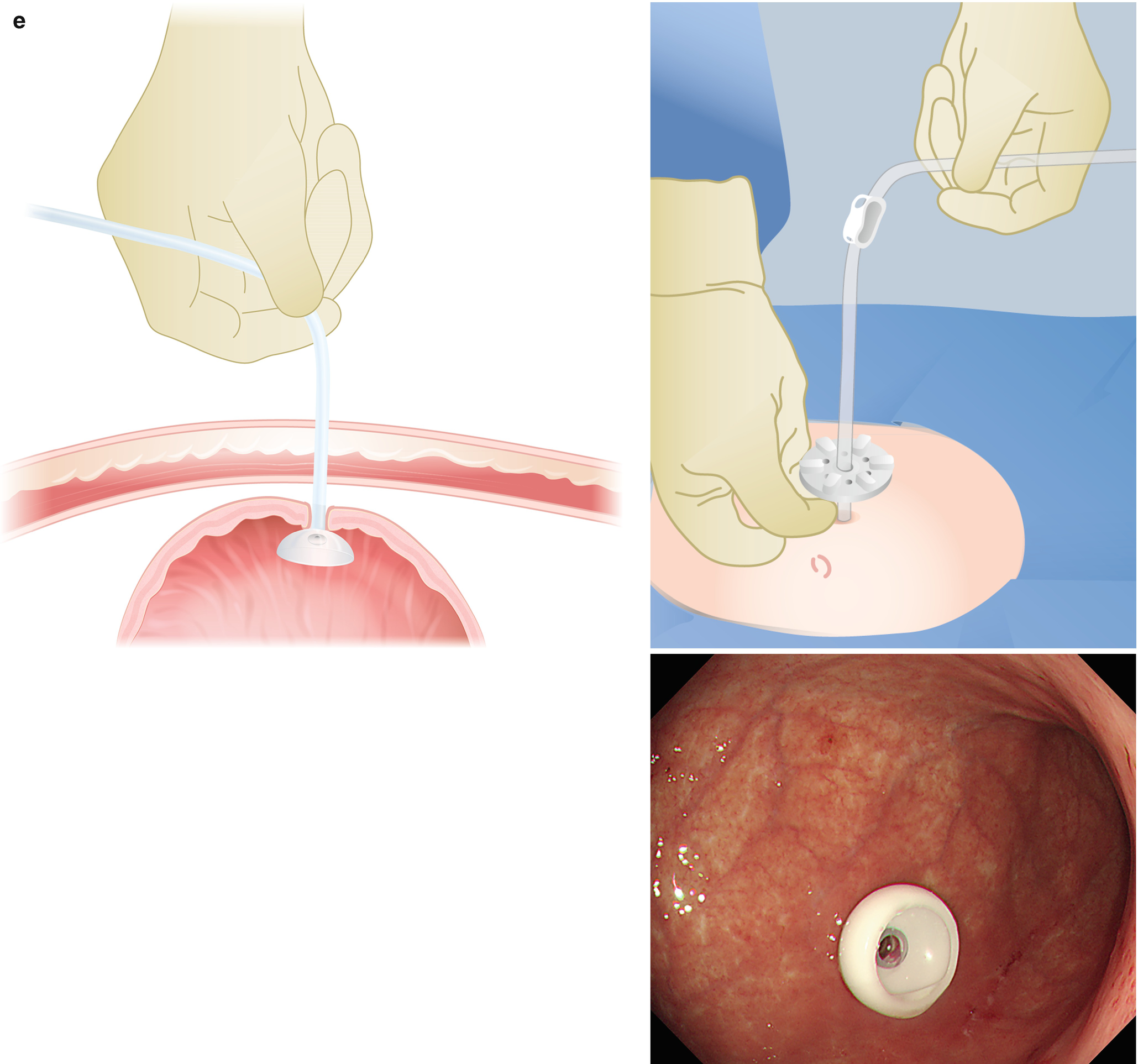 Percutaneous Endoscopic Gastrostomy Springerlink - 