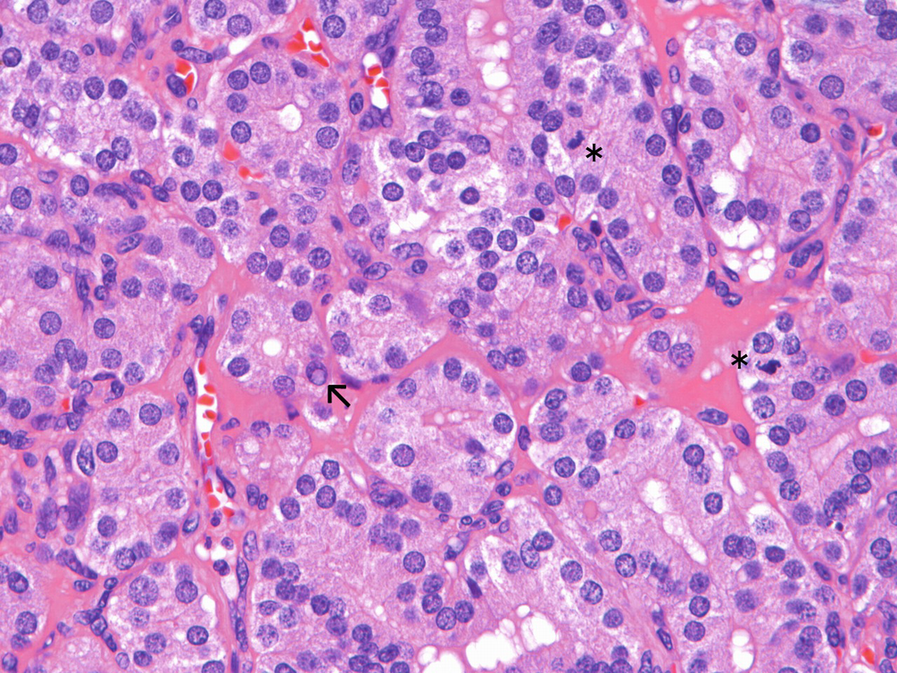 Cytopathology In The Thyroid Of Graves Disease Springerlink