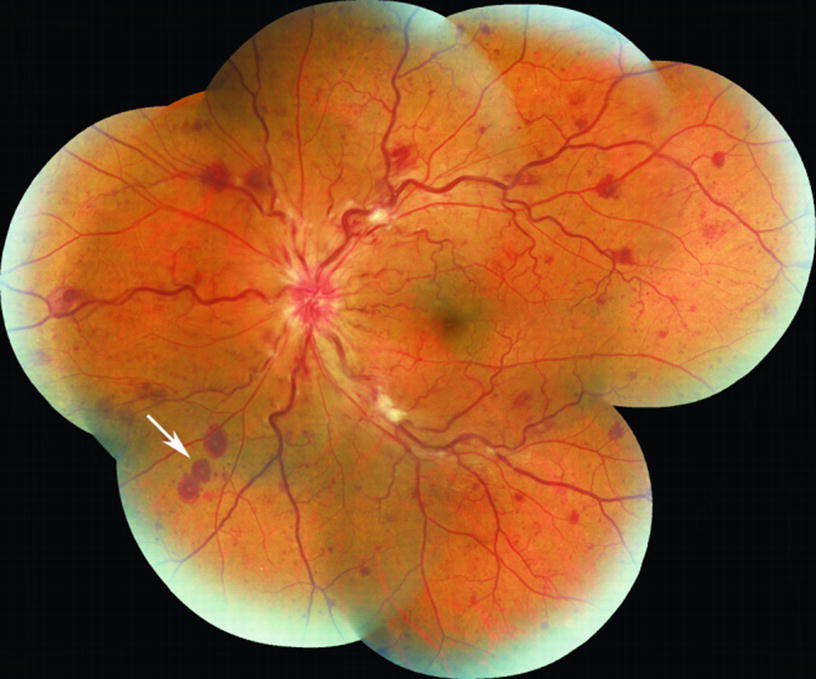 Syphilis The Great Imitator Springerlink