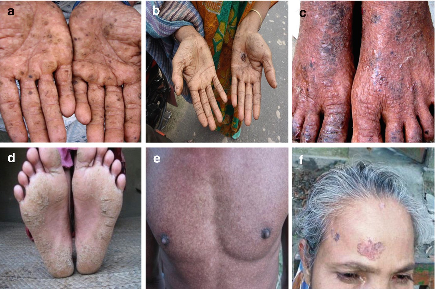 Characteristics And Health Effects Of Arsenic Exposure In Bangladesh Springerlink