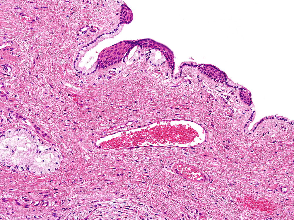Vulvar Ectopic Tissues Cysts And Benign Adnexal Tumors Springerlink
