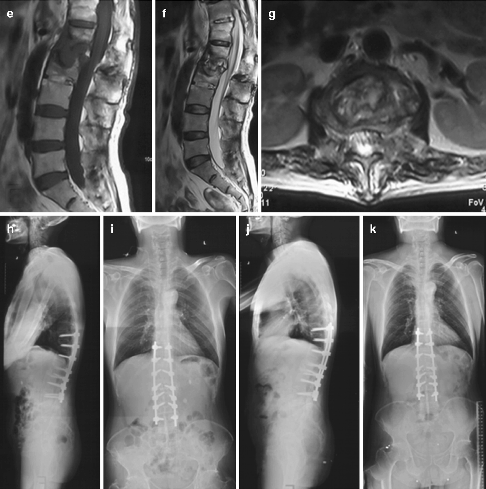 spondylitis ankylopoetica