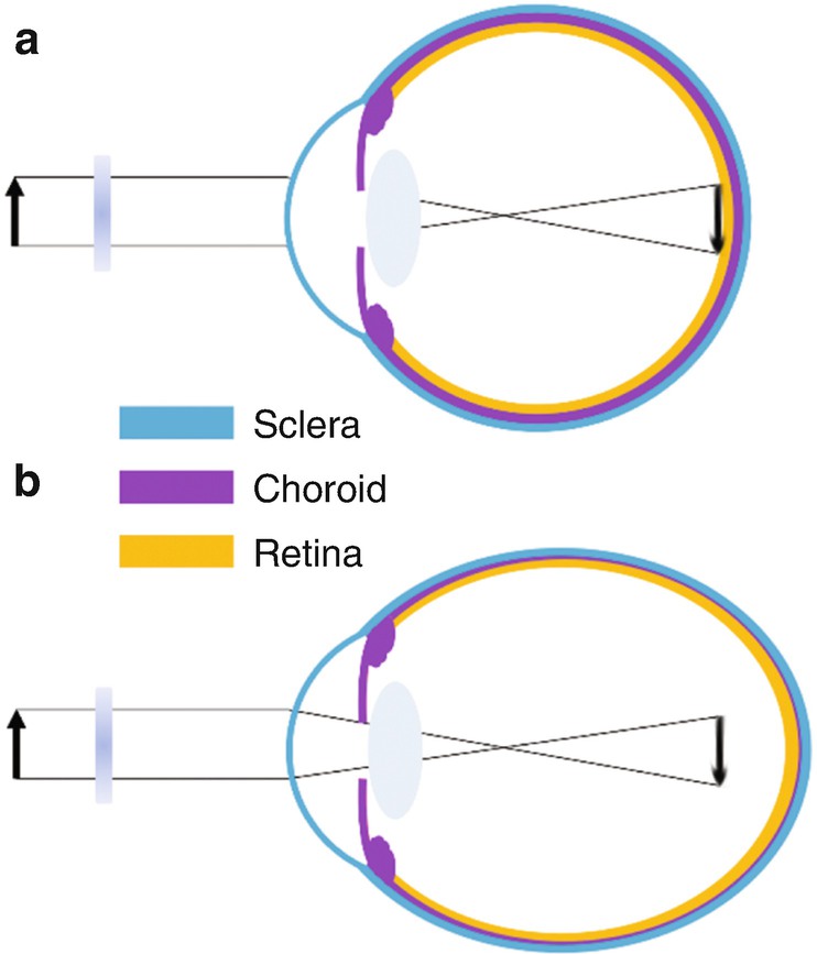 myopia hyperopia progressive