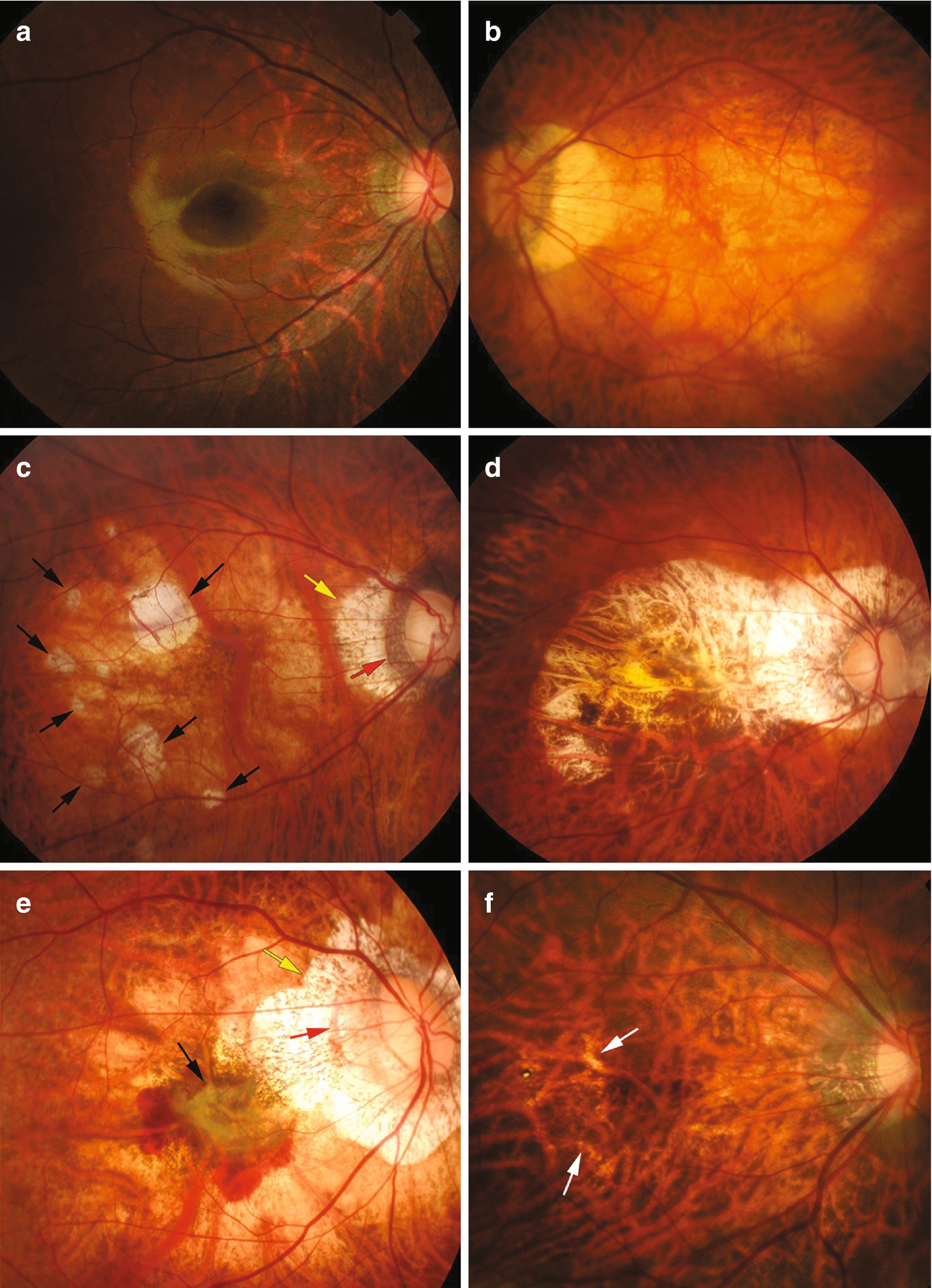 myopia complications retina