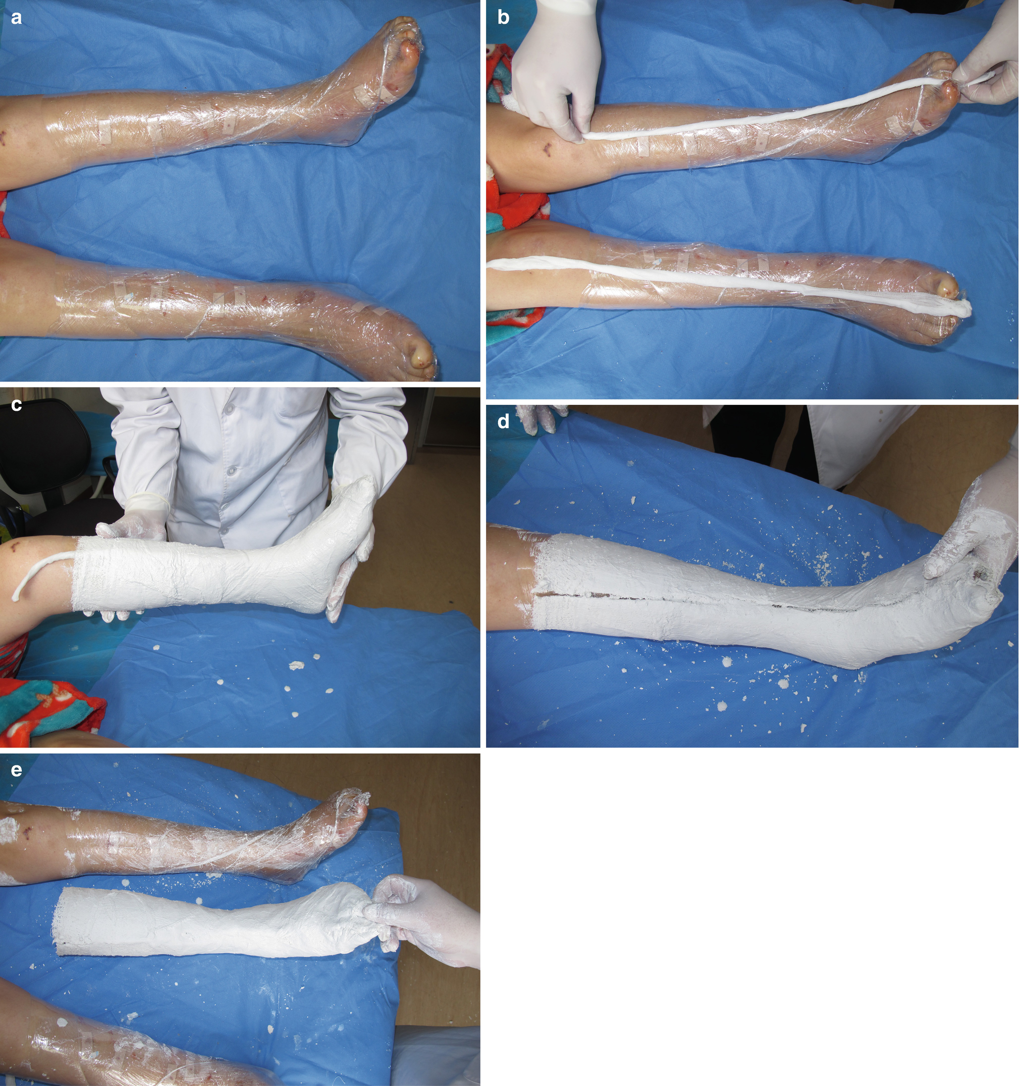 Lower Limb Deformities In Cerebral Palsy Springerlink