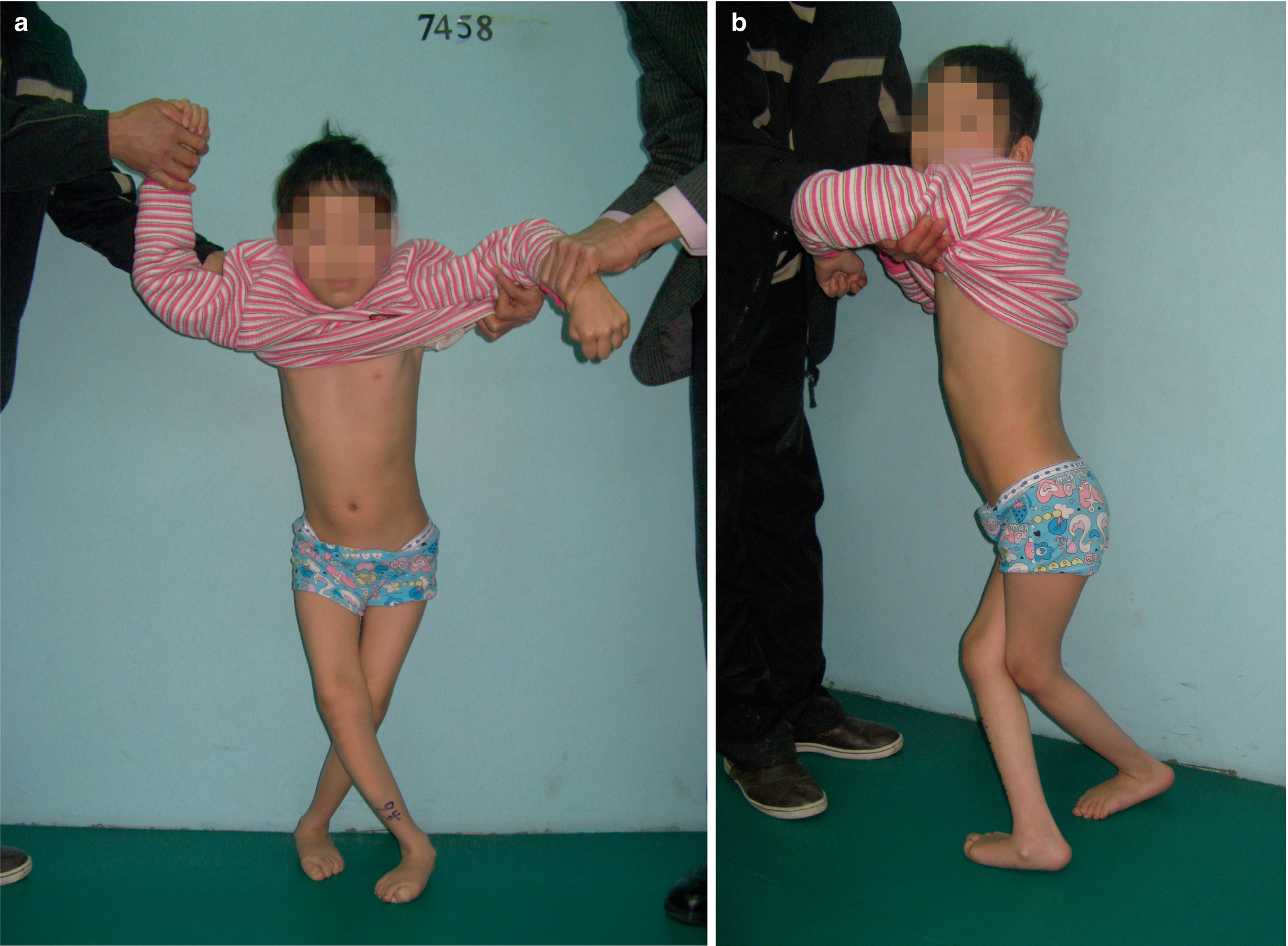 Lower Limb Deformities In Cerebral Palsy Springerlink