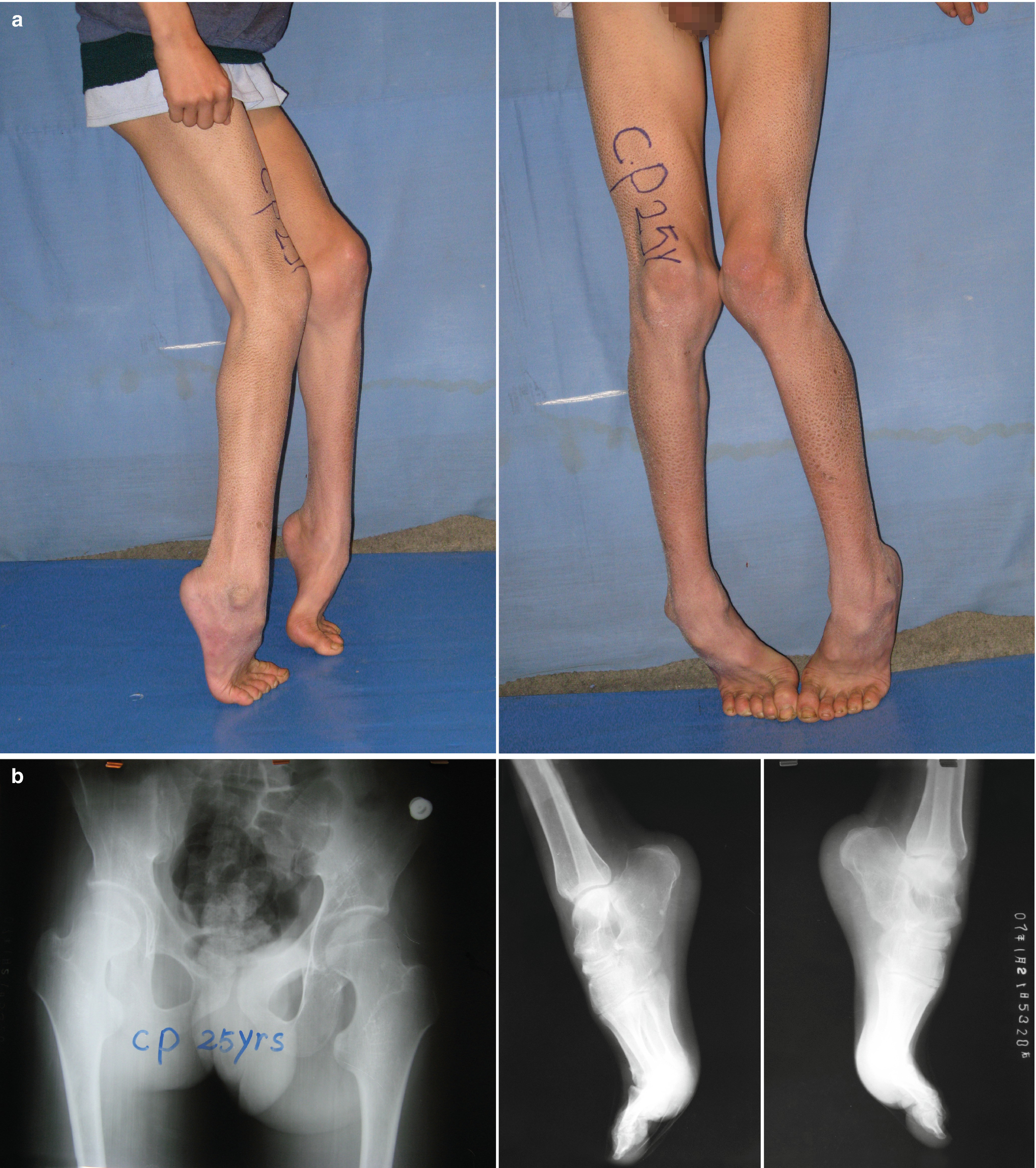 Lower Limb Deformities In Cerebral Palsy Springerlink
