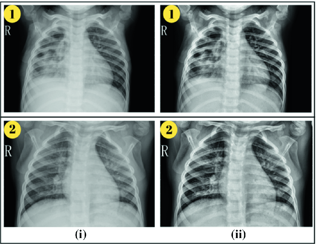 Deep Convolutional Neural Network With Transfer Learning For Detecting Pneumonia On Chest X Rays Springerlink