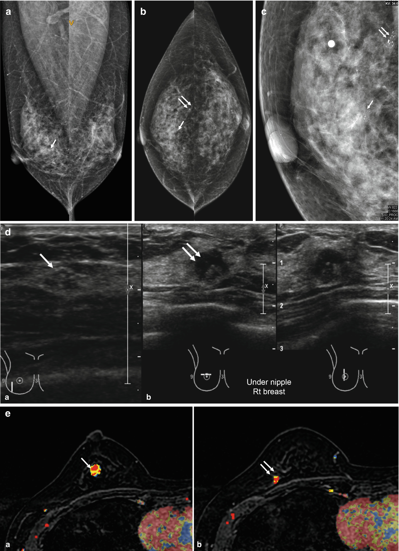 Calcifications Springerlink