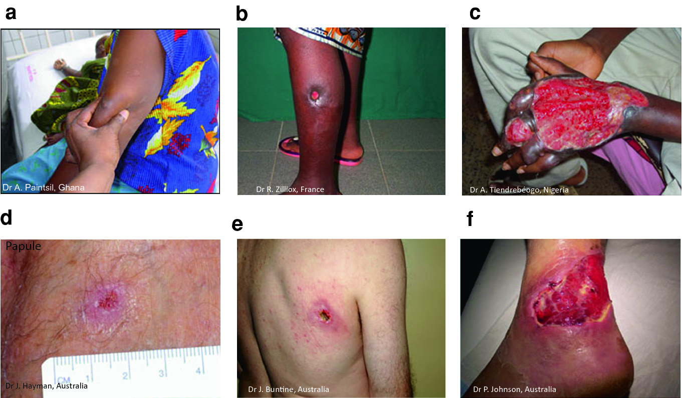 Papillomatosis cutis kezelés - Milyen férgek léteznek