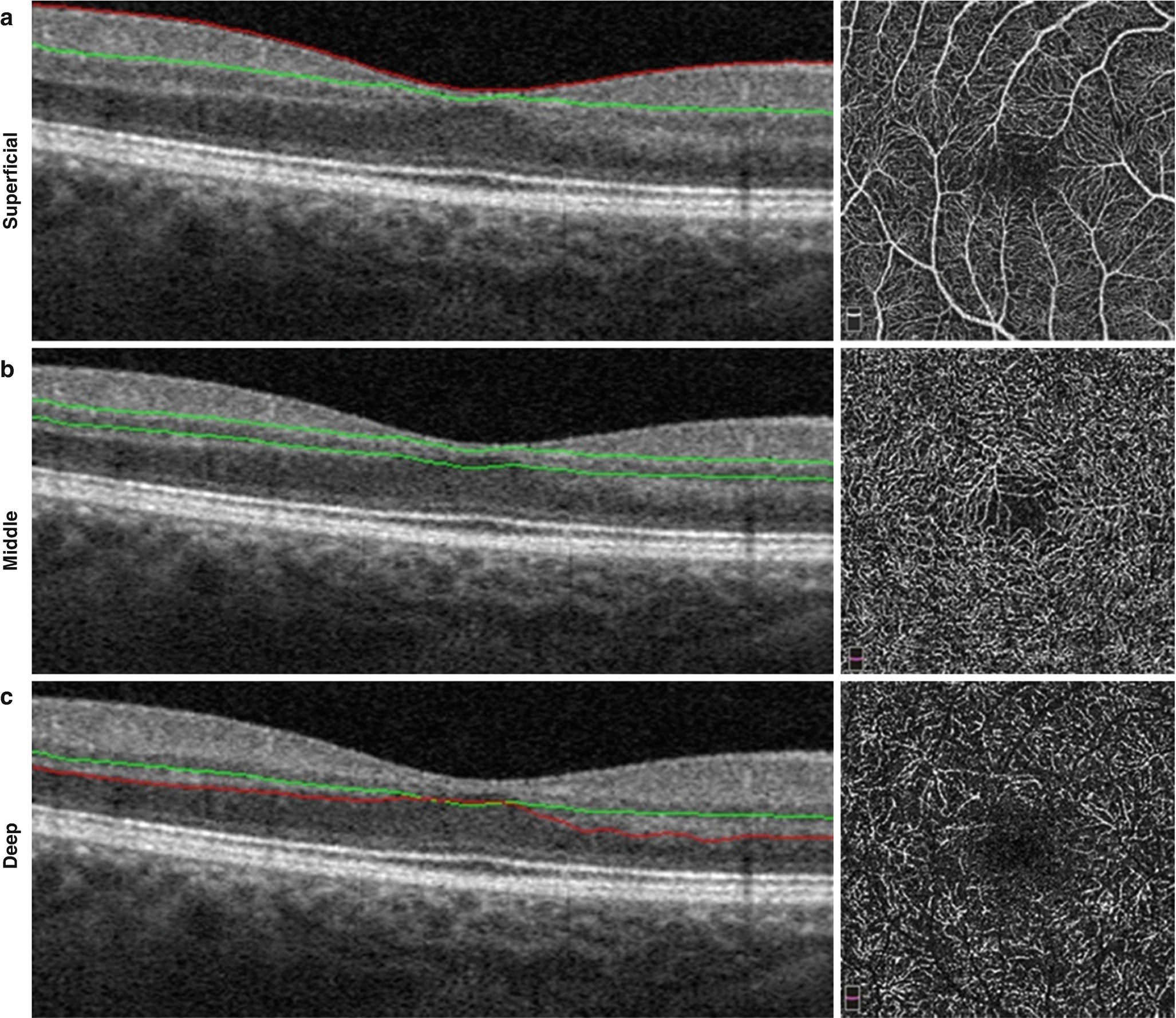 Imaging Of Retinal Vascular Disease Springerlink