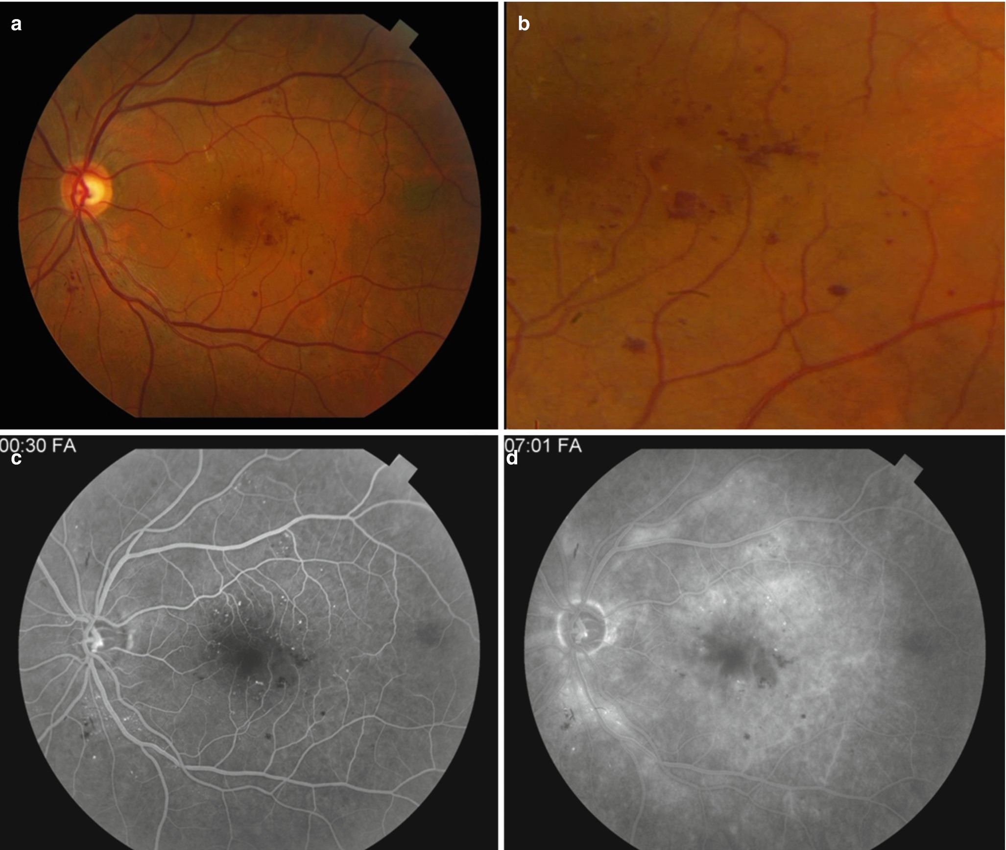 Imaging Of Retinal Vascular Disease Springerlink Imaging Of Retinal Vascular Disease Springerlink